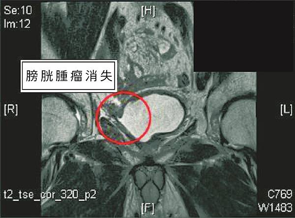 膀胱癌反覆復發 免疫療法彰基醫院治療見效4.jpg