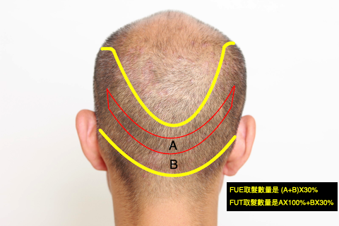 FUT+FUE donor.png FUT+FUE donor.png