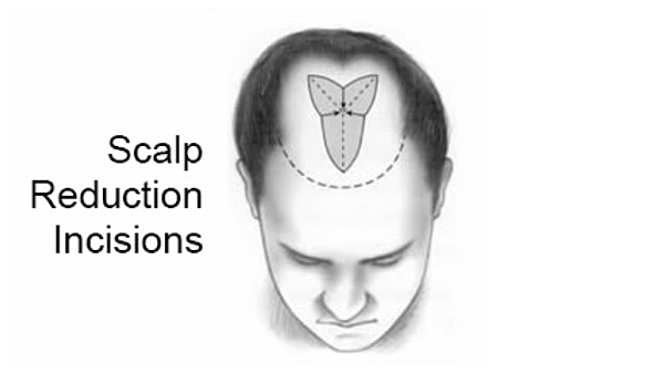 14 scalp reduction illustration.png