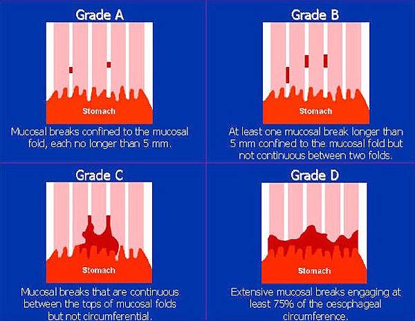 Figure-1_-LA-classification-of-erosive-esophagitis.jpg