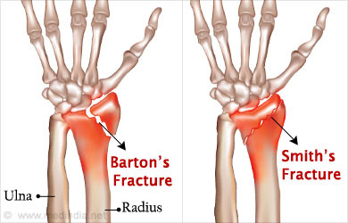types-of-distal-radius-fracture.jpg