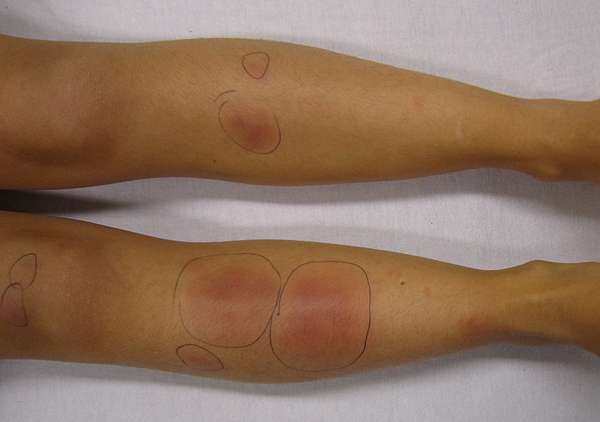 Erythema Nodosum 結節性紅斑 En 醫學筆記匯集整理ed Notes 痞客邦 Erythema Nodosum 結節性紅斑 En 醫學筆記匯集整理ed Notes 痞客邦