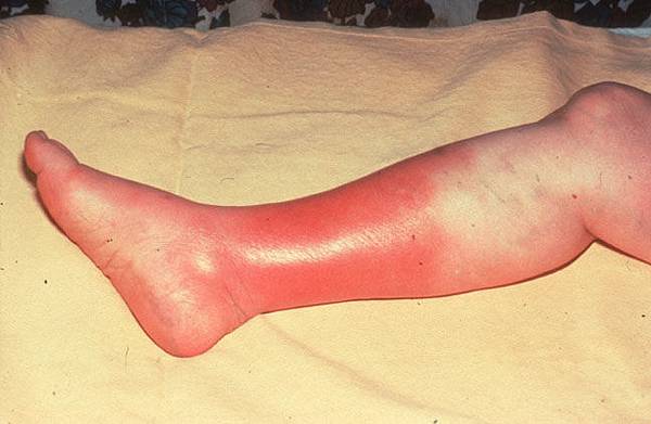 Cellulitis-www.asdk12.org_.jpg