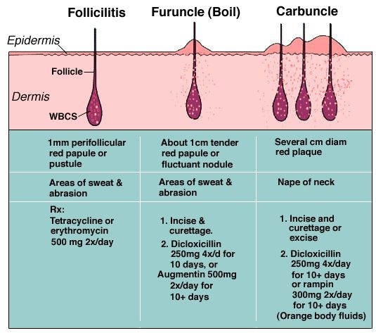 folliculitis_skin_diagram.jpg