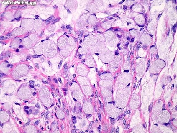 Ovary_Metastases_KrukenbergTumor14.jpg