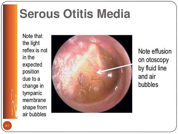 otitis-media-with-effusion-27-638.jpg