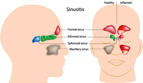 ChronicSinusitis.jpg