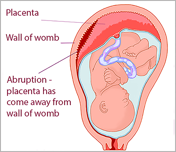 placental abruption large.png