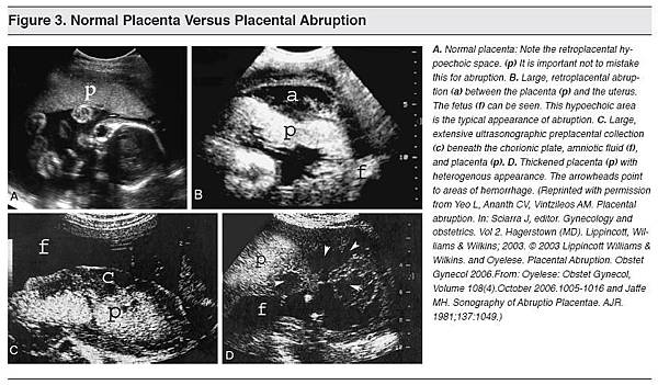 Normal Placental Versus Placental Abruption Emergency Medicine Practice.JPG