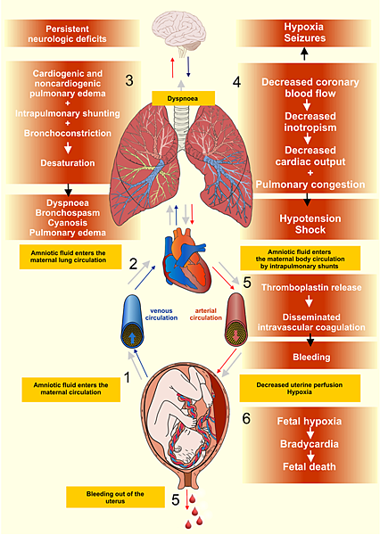 800px-Amniotic_fluid_embolism.png