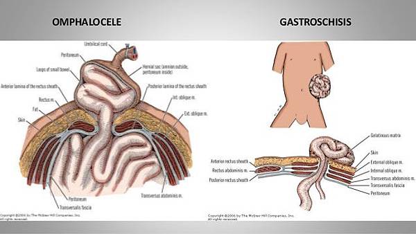 omphalocele-vs-gastroschisis-8-638.jpg