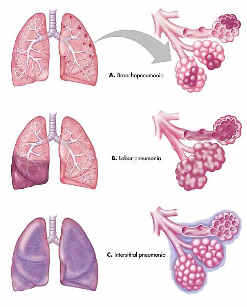 attelu-rezultati-vaicajumam-bronchopneumonia.jpeg