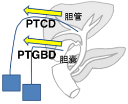 PTCD vs PTGBD.gif