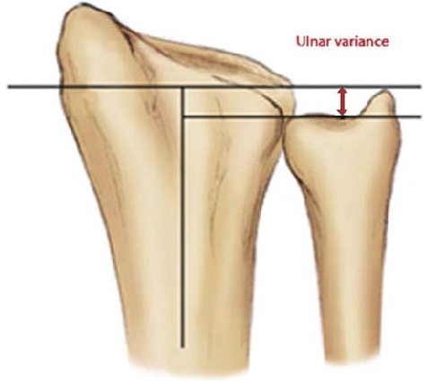 Fig-3-Ulnar-variance.png