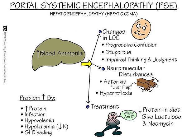 portal-systemic-encephalopathy.jpg