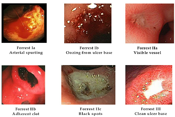 Endoscopic-grading-according-to-Forrest-classification.png