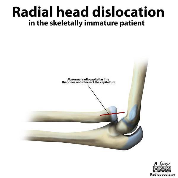 illustration-radial-head-dislocation_orig.jpg