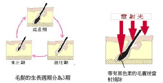 永久除毛的原理為何02