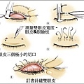 台中縫雙眼皮01