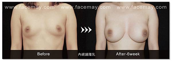 隆乳案例2.jpg