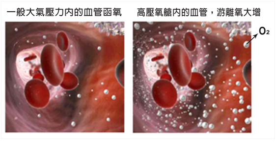 高壓氧護理-3.jpg