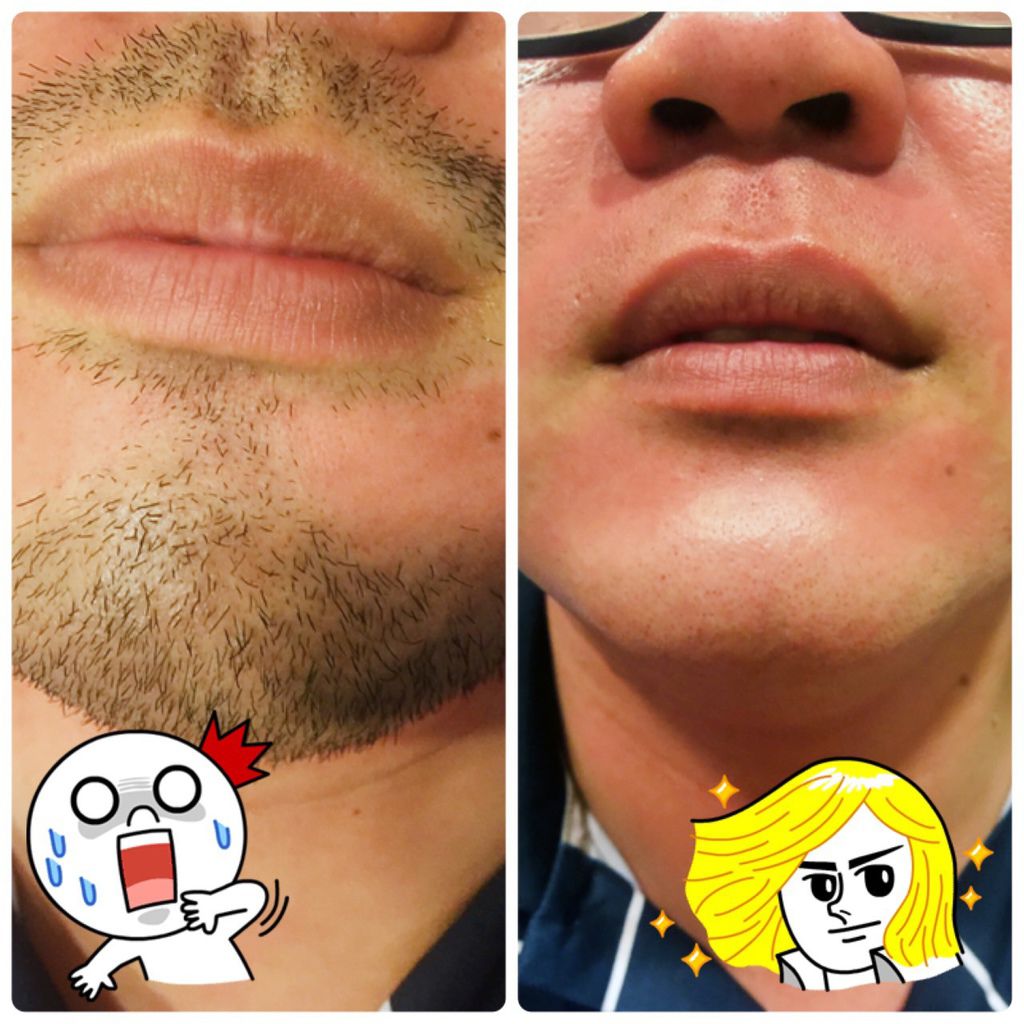 |台南除毛|+台南朵菈形象美學館+ 拒絕鬍渣滿臉,輕鬆化身乾淨型男!