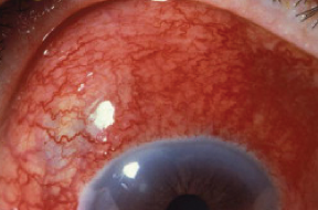 鞏膜炎 Scleritis 乃可致盲必须及時治療 希瑪林順潮眼科中心的部落格 痞客邦
