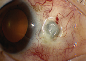 鞏膜炎 Scleritis 乃可致盲必须及時治療 希瑪林順潮眼科中心的部落格 痞客邦