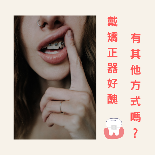 舌側矯正04.png