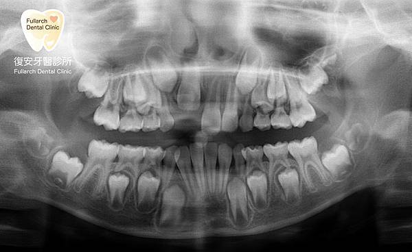 20200804因為是乳牙所以蛀牙沒關係-03