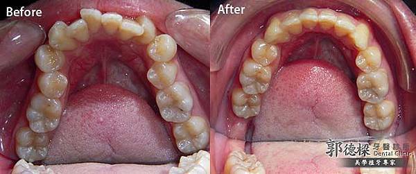 牙齒矯正解決牙齒排列不整問題