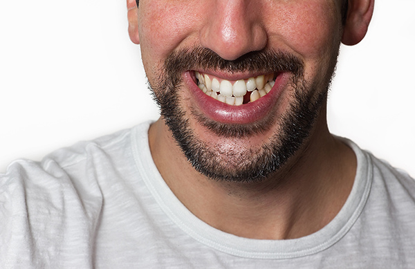 年紀大掉牙正常？！假牙牙套幫助有限，更可能引起嚴重牙周病與口腔健康問題