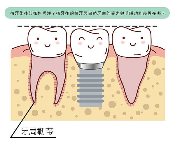 植牙術後該如何照護？植牙後的植牙與自然牙齒的受力與咀嚼功能差異在哪？