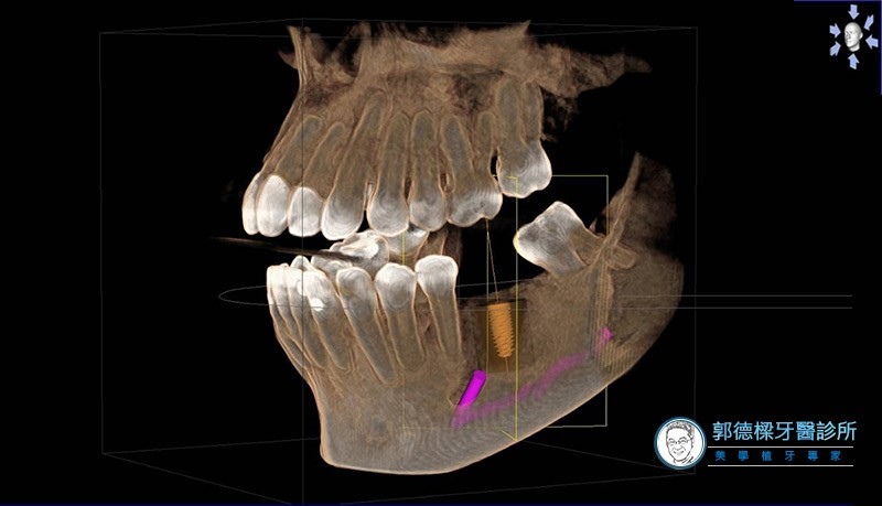 進行植牙前，一定要拍攝3D電腦斷層掃描嗎？