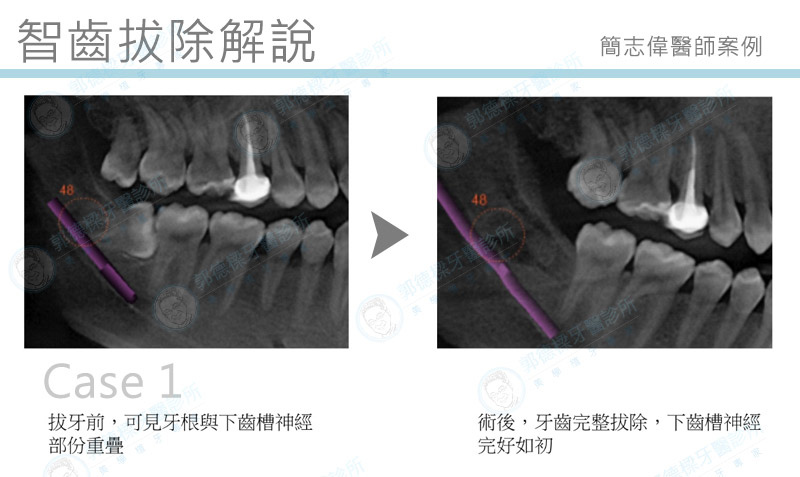 智齒拔除解說，簡志偉醫師.jpg