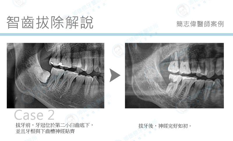 智齒拔除解說，簡志偉醫師.jpg