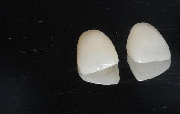 3 after cementation