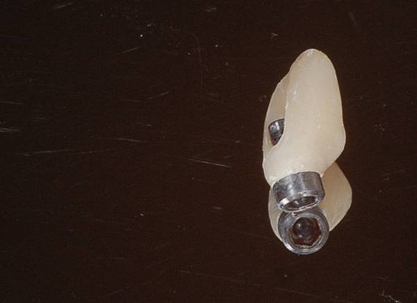 2 temporary abutment (2).JPG