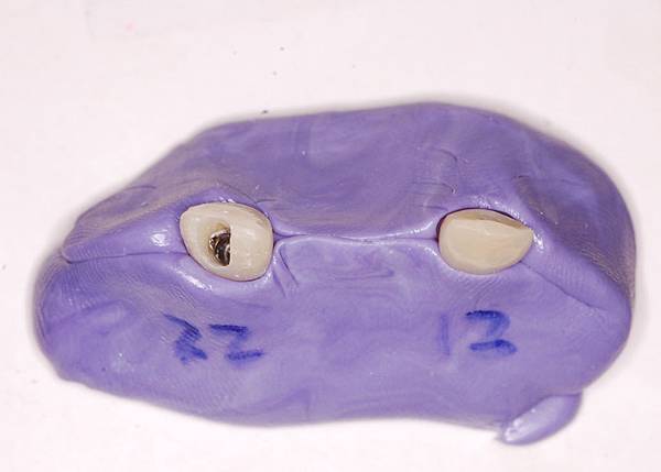 4. custom impression coping.JPG