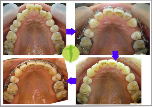 右上及左上拔除第一小臼齿,将上颚前牙向内移动,以减少外凸的情形.