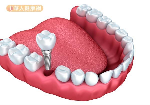 缺牙一定要植牙嗎？台大牙醫師全解答！