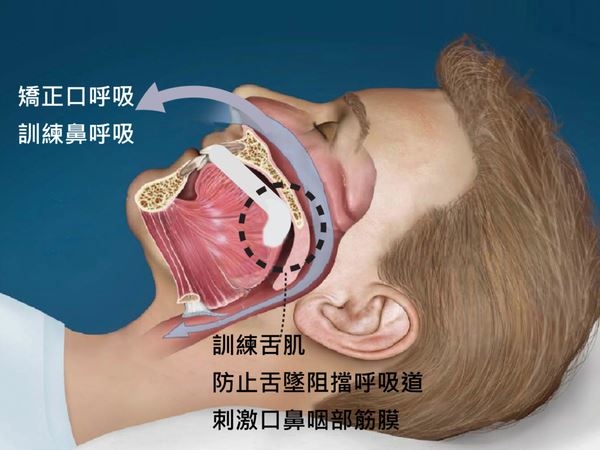 牙套解除大患 遠渡重洋擺脫睡眠呼吸中止症3 牙套解除大患 遠渡重洋擺脫睡眠呼吸中止症3