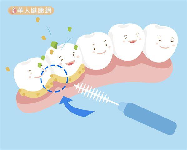 口腔清潔只靠刷牙太天真！善用牙間刷、牙線棒護牙一把罩2