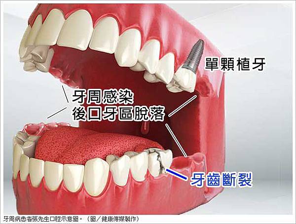 牙齒各司其職缺一不可 植牙不讓好牙應聲倒2 牙齒各司其職缺一不可 植牙不讓好牙應聲倒2