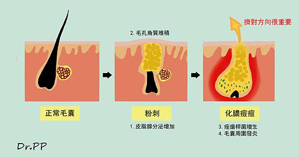 1061008擠青春痘-01.jpg