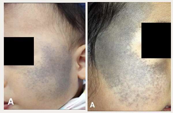 臉上的胎記 太田母斑 Nevus Of Ota 跟著皮皮愛漂亮 痞客邦