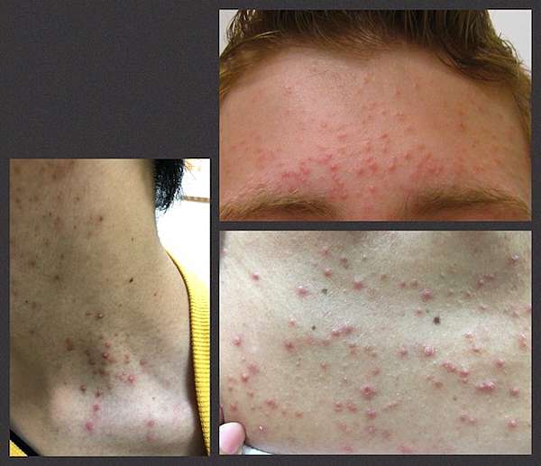 你的痘痘不是痘 皮屑芽孢菌毛囊炎 Pityrosporum Folliculitis 跟著皮皮愛漂亮 痞客邦
