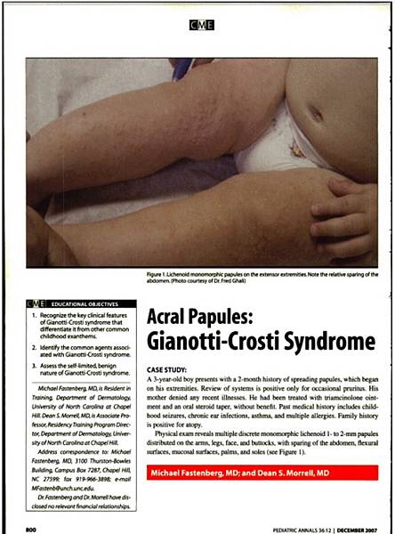 小兒丘疹性肢端皮膚炎