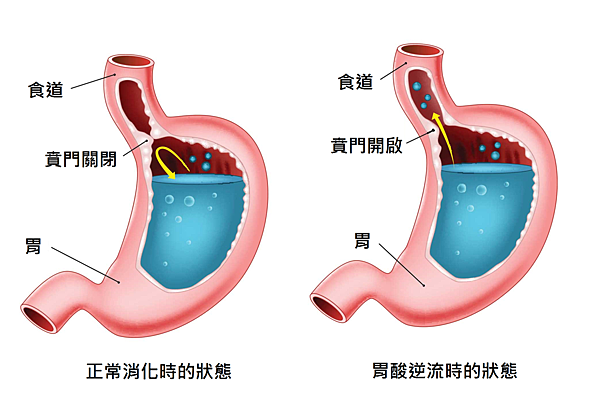 胃食道逆流的描述.png