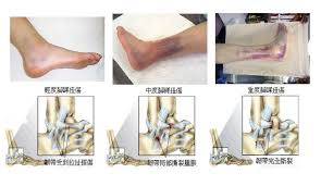 「腳踝扭傷的急性處理」的圖片搜尋結果